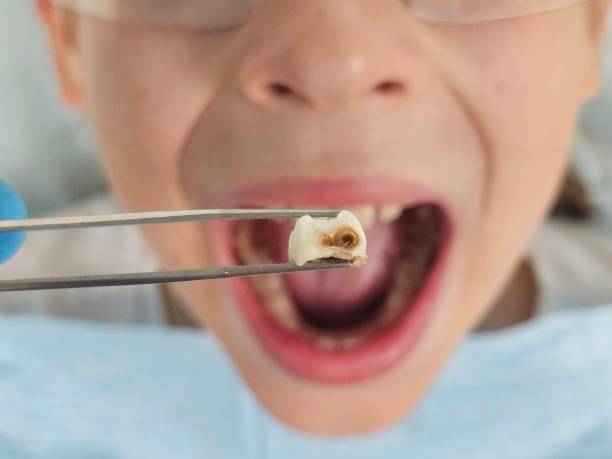 Best Emergency Tooth Extraction in Bellaire, OH